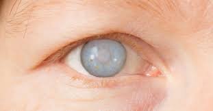 Cataract